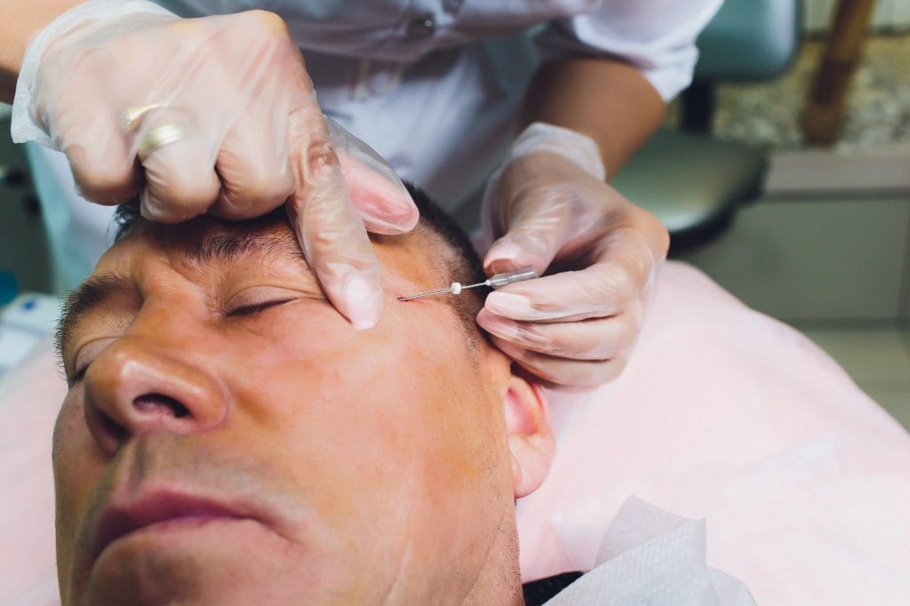 PDO Threading: A Minimally Invasive Way to Lift and Refresh Your Appearance